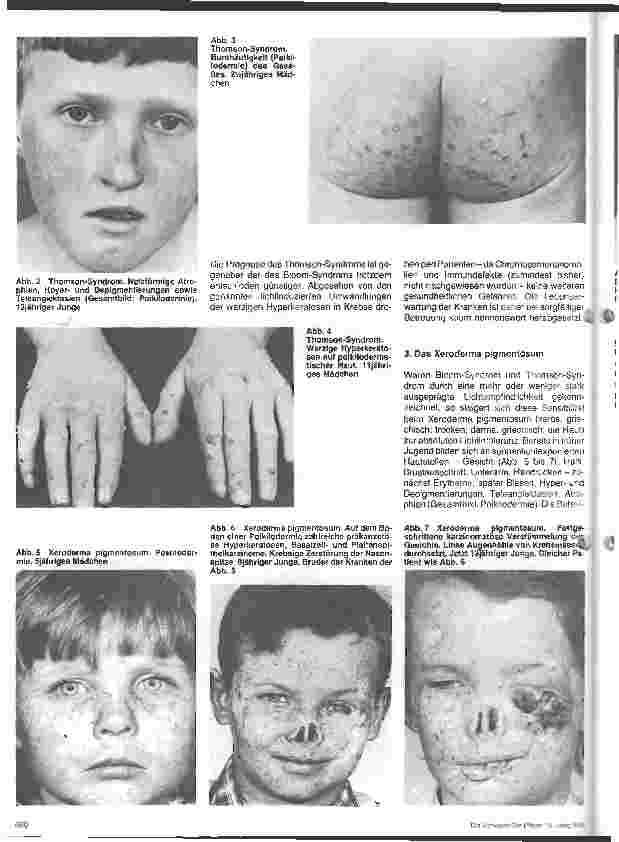 Vorschauseite 2: Hautärztliche Blick-Diagnose von Erbkrankheiten: Erbliche Poikilodermien - 4. Folge