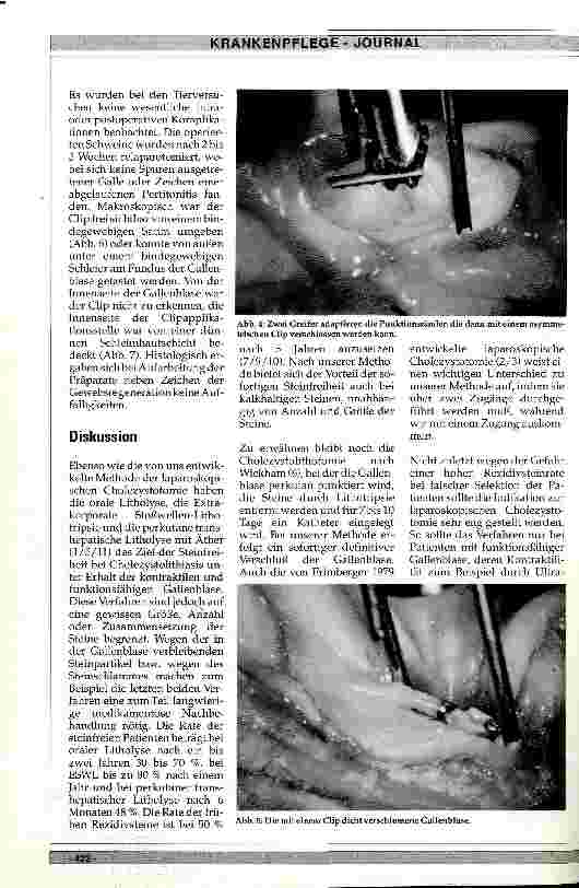 Vorschauseite 3: Die laparoskopische Cholezystotomie