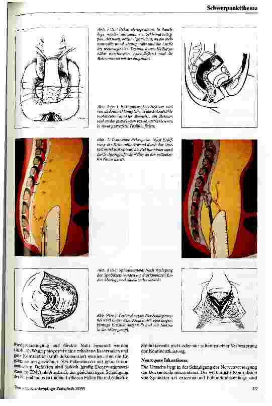 Vorschauseite 4: Obstipation - Stuhl-Inkontinenz Diagnostik und chirurgische Therapie