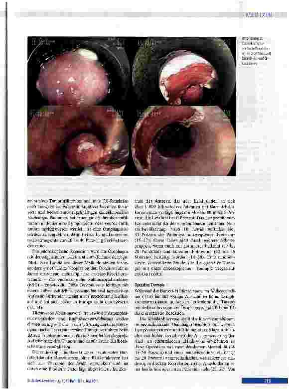 Vorschauseite 3: Barrett-Karzinom der Speiseröhre