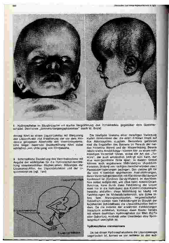 Vorschauseite 2: Zur Diagnostik und Therapie des kindlichen Hydrozephalus
