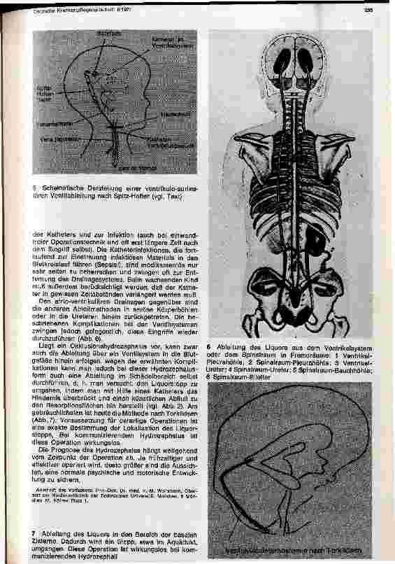 Vorschauseite 5: Zur Diagnostik und Therapie des kindlichen Hydrozephalus