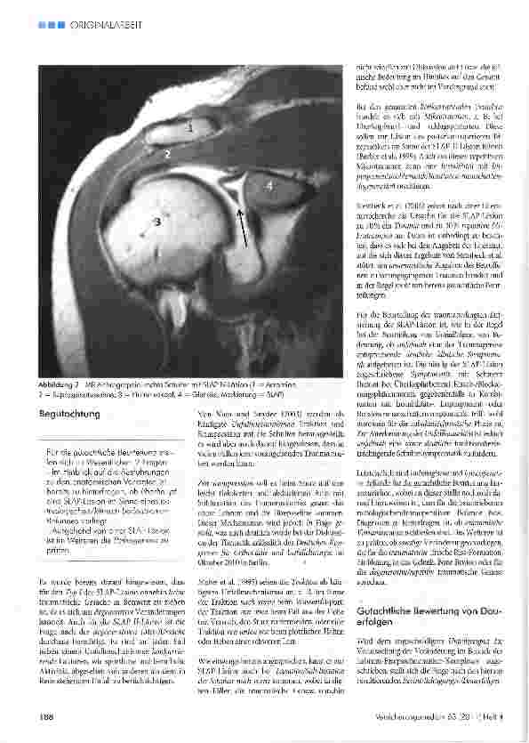 Vorschauseite 3: Relevante Aspekte der gutachtlichen Beurteilung der SLAP-Läsion Traumatische Veränderungen versus degenerative/anlagebedingte Veränderungen