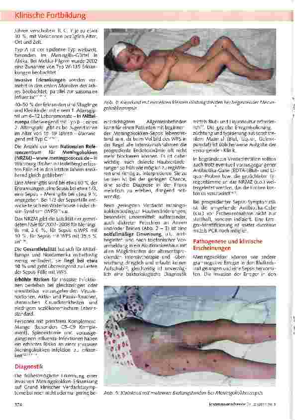 Vorschauseite 2: Meningokokken-Sepsis und -Meningitis