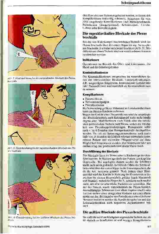 Vorschauseite 3: Die Blockade des Plexus brachialis