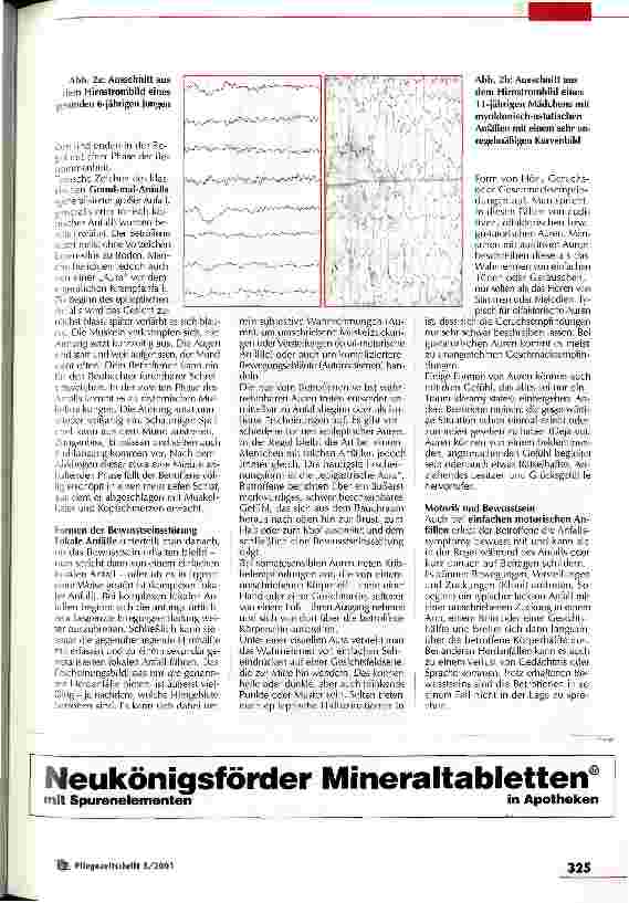 Vorschauseite 3: Was ist eigentlich Epilepsie? Weit verbreitet und trotzdem tut Aufklärung not