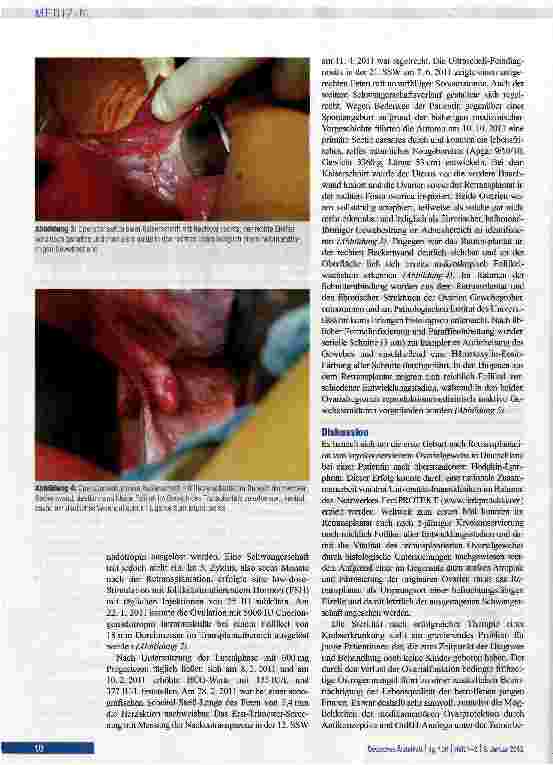 Vorschauseite 3: Retransplantation von kryokqnserviertem Ovarialgewebe: Erste Geburt in Deutschland