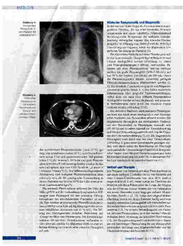 Vorschauseite 2: Behandlungskonzepte der Pleurakarzinose mit malignem Pleuraerguss