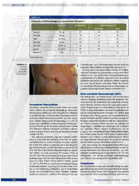 Vorschauseite 4: Behandlungskonzepte der Pleurakarzinose mit malignem Pleuraerguss