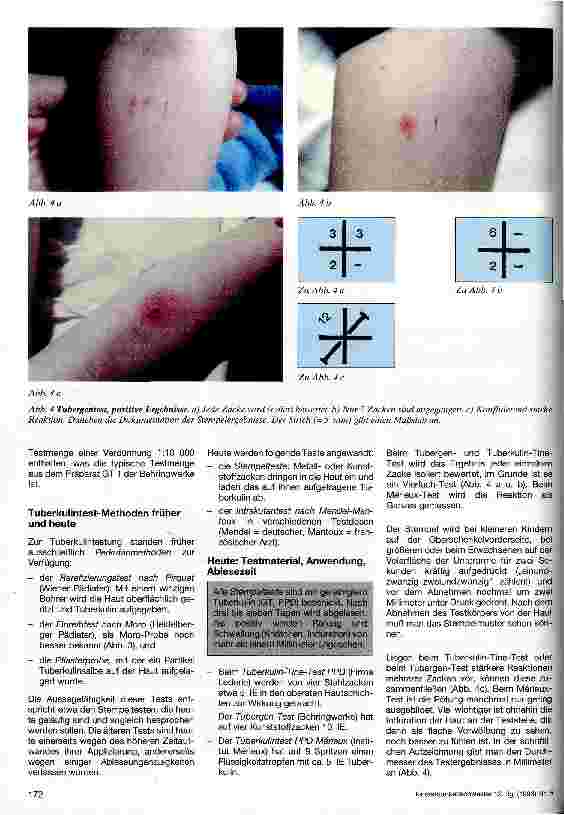 Vorschauseite 3: Der Tuberkulintest Definitionen, Material, Technik, Aussage