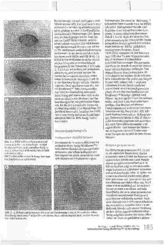 Vorschauseite 3: Antibakterieller Honig (Medihoney™) zur Wundpflege Wundantisepsis bei pädiatrischen Patienten in der Hämatologie-Onkologie?