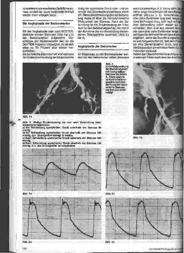 Vorschauseite 2: Gefäßkrankheiten/Die Angioplastie, eine moderne Katheterbehandlung bei der arteriellen Verschlußkrankheit