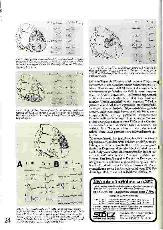 Vorschauseite 4: EKG-Veränderungen beim Herzinfarkt