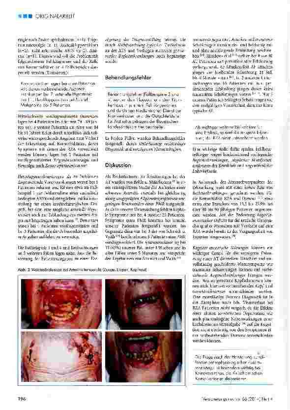 Vorschauseite 4: Bilateraler Visusverlust bei der Arteriitis temporalis eine vermeidbare Komplikation?Beobachtungen an 23 Patienten