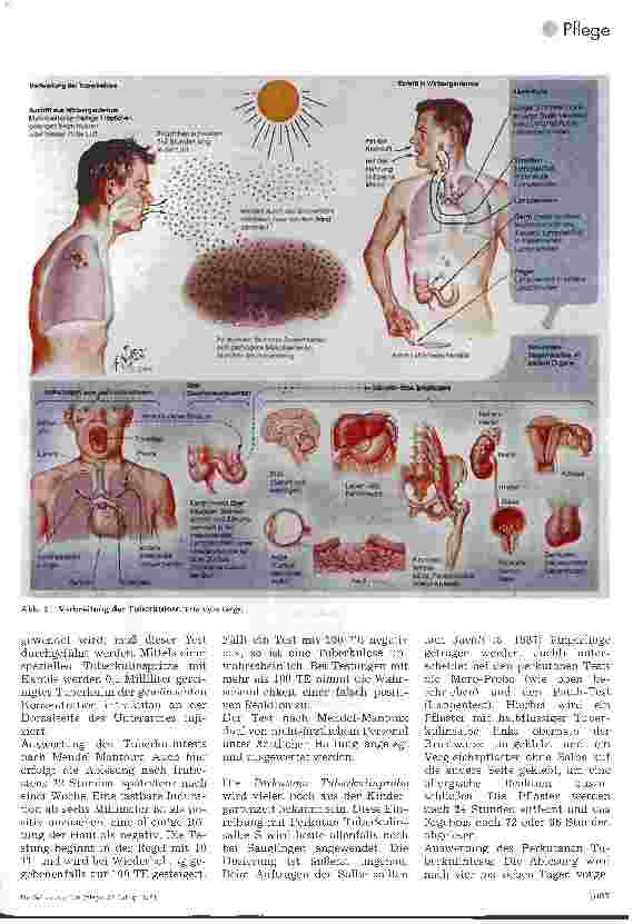Vorschauseite 2: Tuberkulose 2. Teil: Tuberkulintest, Therapie, pflegerische Maßnahmen