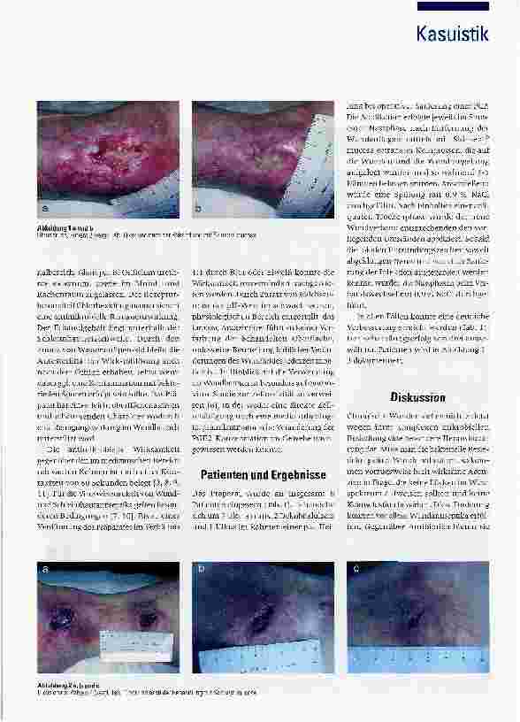 Vorschauseite 2: Behandlung chronischer Wunden mit Skinsept mucosa: Erfahrungen mit einem Schleimhautantiseptikum