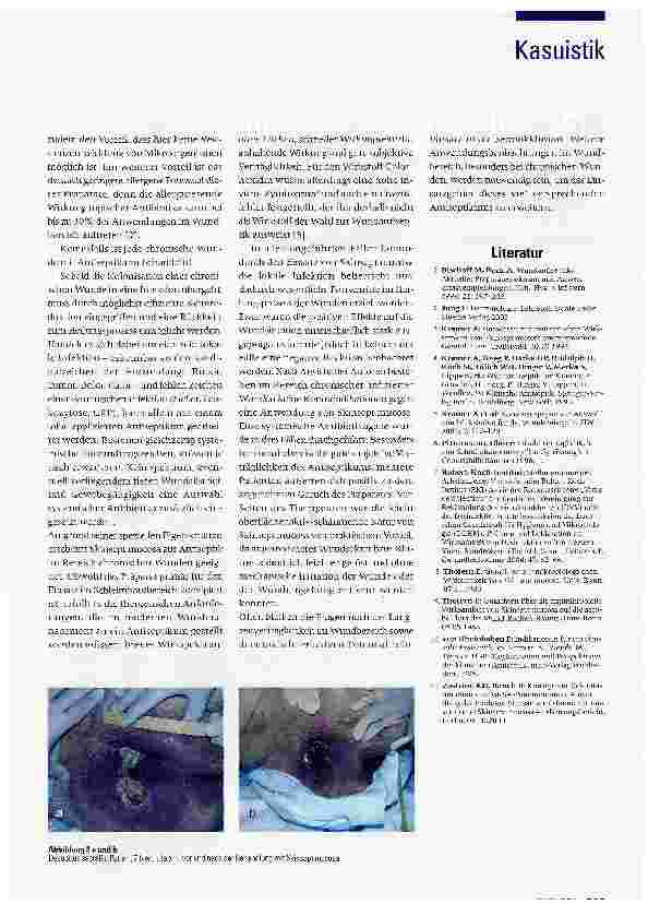 Vorschauseite 4: Behandlung chronischer Wunden mit Skinsept mucosa: Erfahrungen mit einem Schleimhautantiseptikum