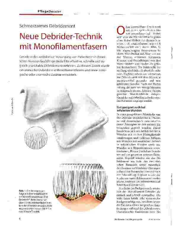 Vorschauseite 1: Neue Debrider-Technik mit Monofilamentfasern