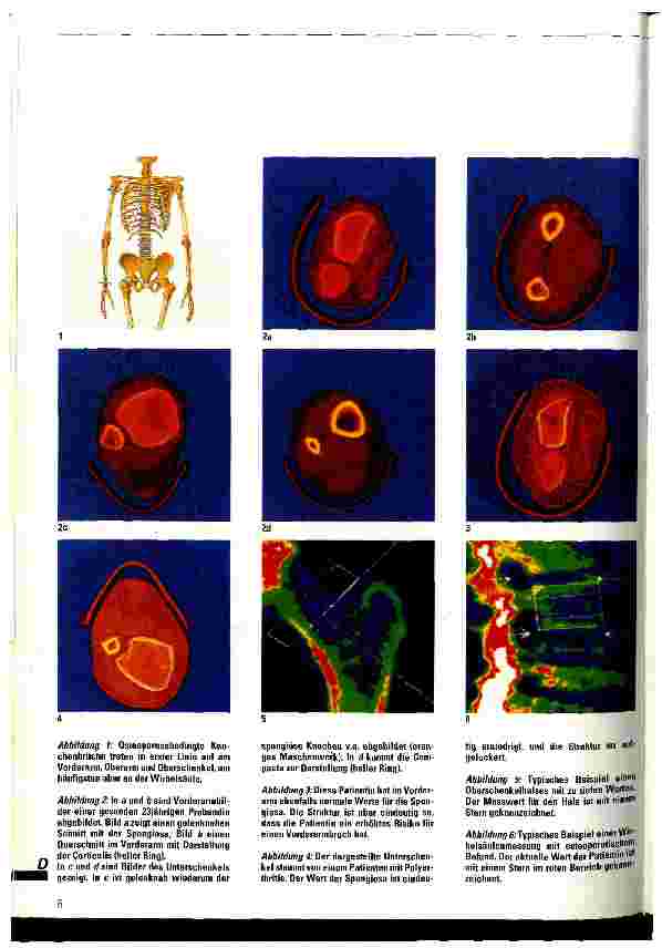 Vorschauseite 3: Osteoporose Definition, Diagnose und Therapie
