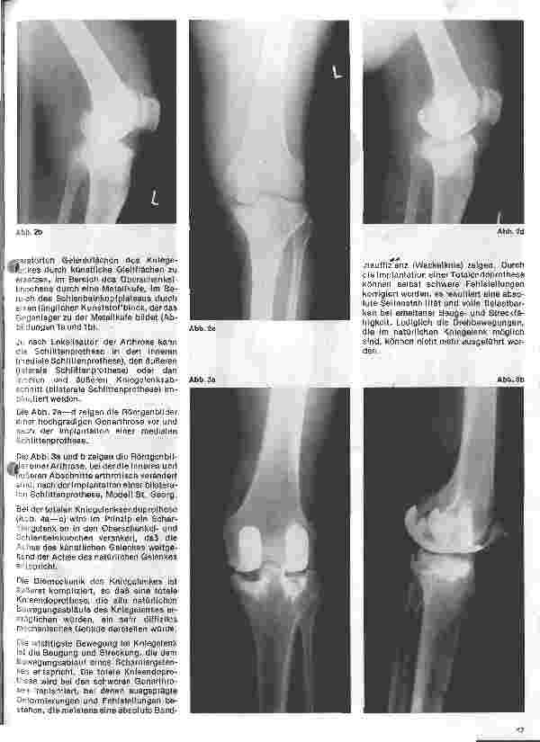 Vorschauseite 2: Moderne Entwicklung in der Orthopädie Das künstliche Kniegelenk
