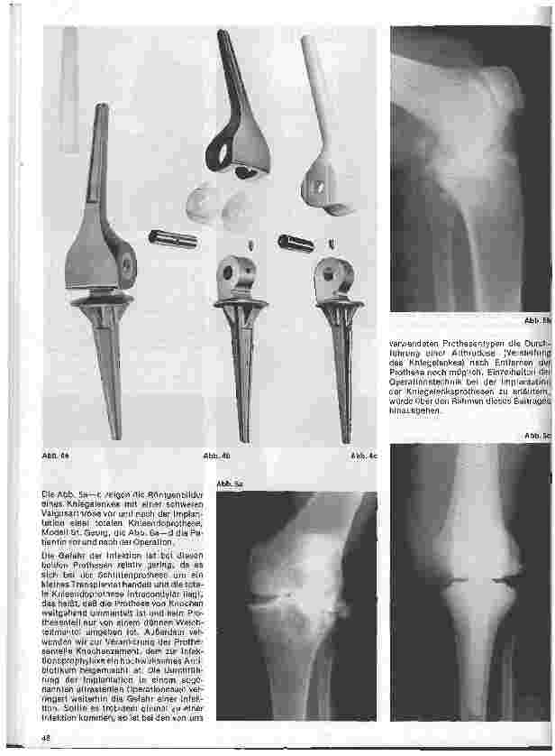 Vorschauseite 3: Moderne Entwicklung in der Orthopädie Das künstliche Kniegelenk