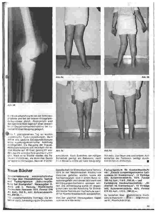 Vorschauseite 4: Moderne Entwicklung in der Orthopädie Das künstliche Kniegelenk