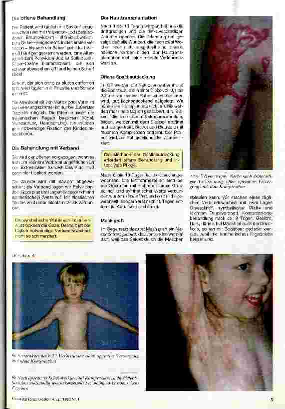 Vorschauseite 4: Behandlungspflege und Kompressionstherapie bei Verbrennungen im Kindesalter