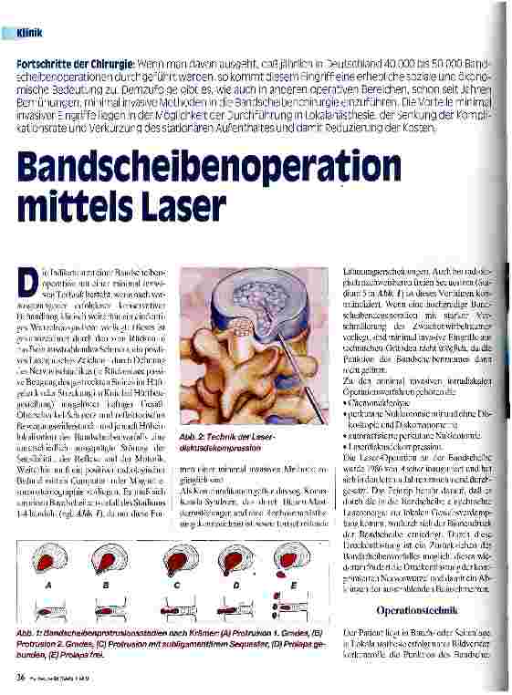 Vorschauseite 1: Bandscheibenoperation mittels Laser