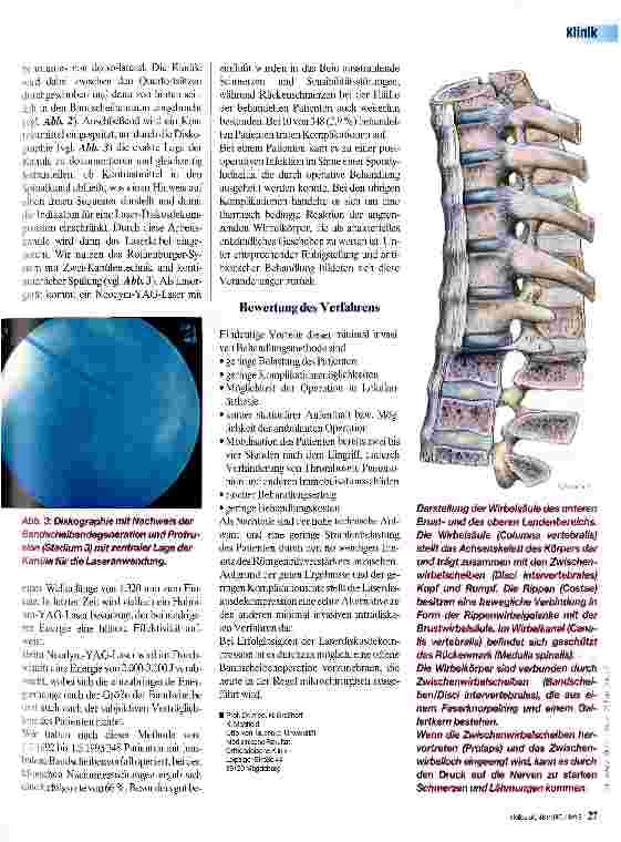 Vorschauseite 2: Bandscheibenoperation mittels Laser
