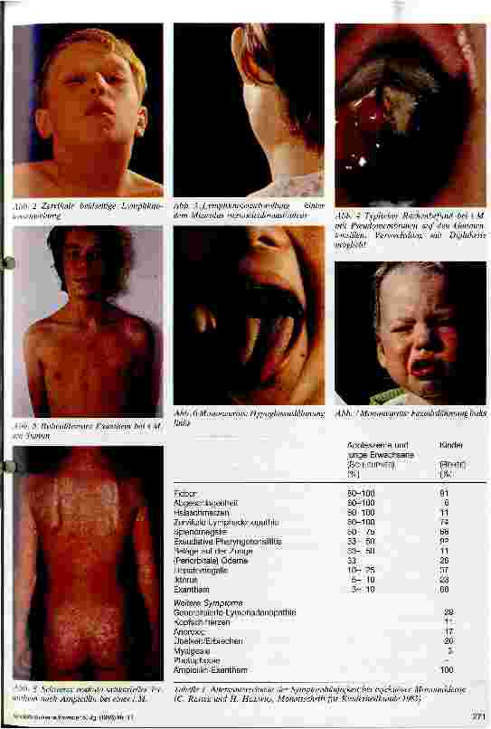 Vorschauseite 2: Infektiöse Mononukleose Geschichte - Pathogenese - Epidemiologie