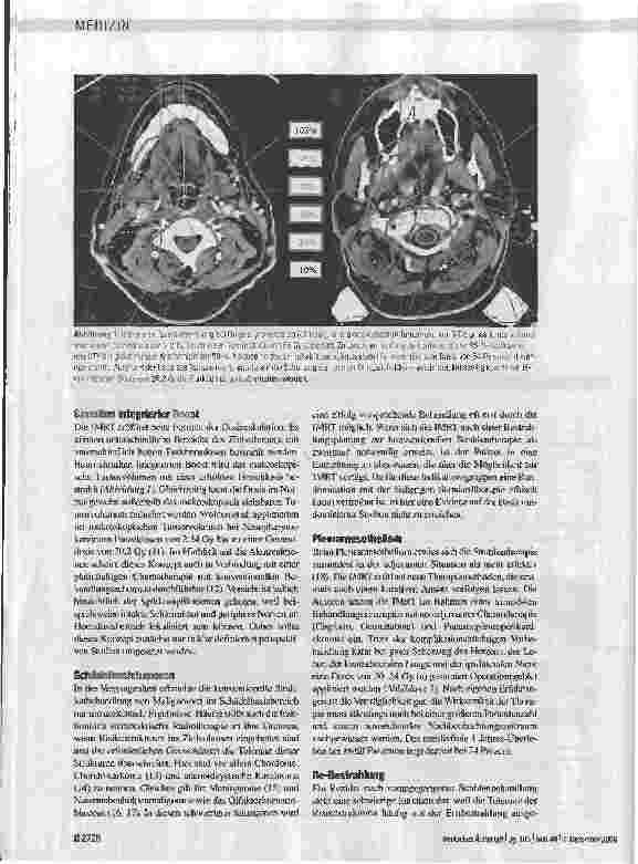 Vorschauseite 4: Intensitätsmodulierte Strahlenbehandlung - neue Perspektiven für die Tumortherapie