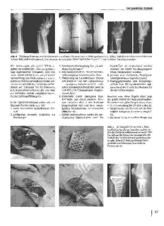 Vorschauseite 4: Kalziumphosphatverbindungen zum Knochenersatz