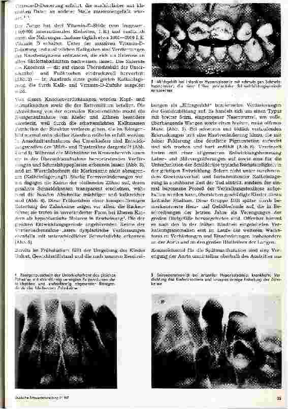 Vorschauseite 3: Das Syndrom der infantilen Hyperkalzämie