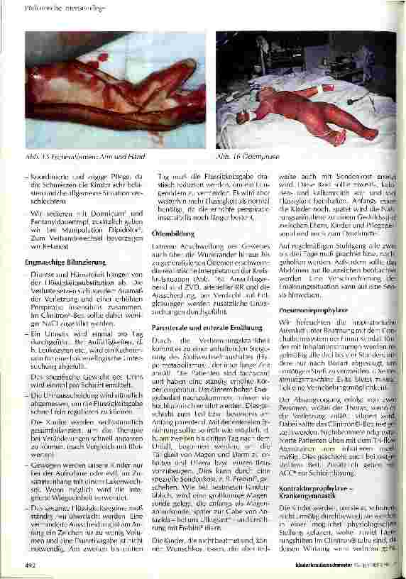 Vorschauseite 5: Besonderheiten bei der Versorgung des schwerbrandverletzten Kindes