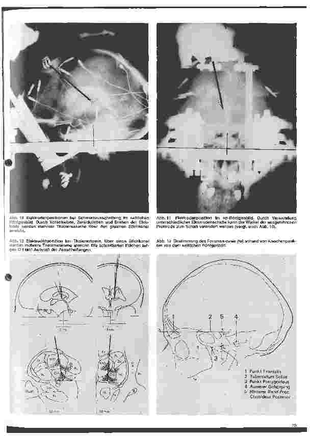 Vorschauseite 5: Themen aus der Neurochirurgie 12 Folge: Stereotaktische Operationen