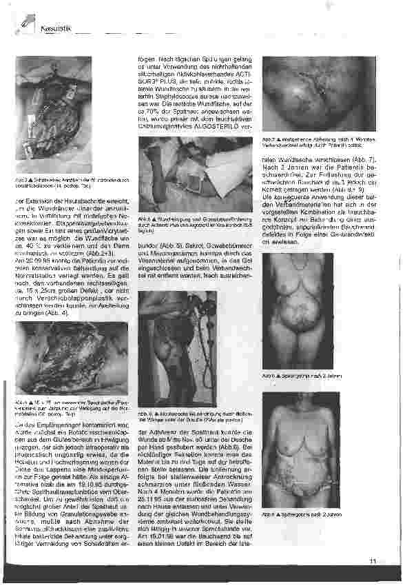 Vorschauseite 2: Wundversorgung eines ausgedehnten Bauchdeckendefektes durch Gasbrand Bauchdeckenresektion infolge einer Nekrose durch Clostidium septicum Infektion