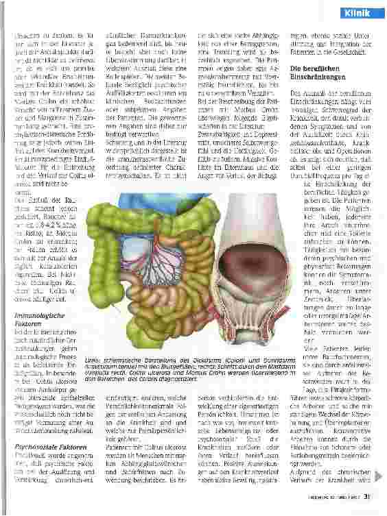 Vorschauseite 2: Morbus Crohn und Colitis ulcerosa