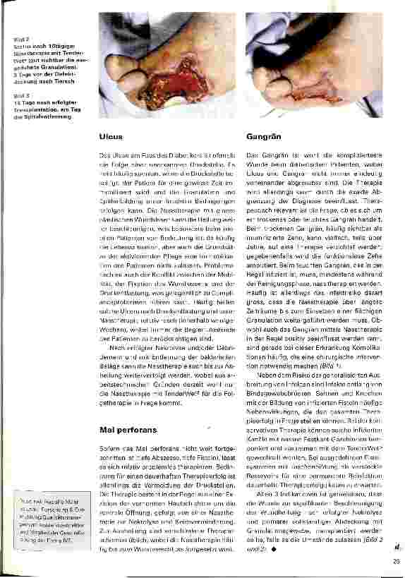 Vorschauseite 2: Problemwunden beim Diabetikerfuß