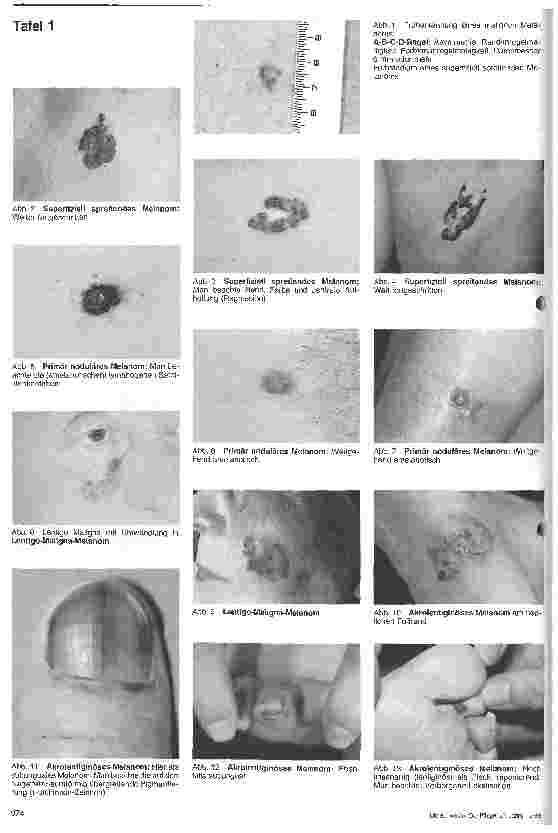 Vorschauseite 3: Der lebensrettende Blick Frühdiagnostik des malignen Melanoms: Wichtig und segensreich