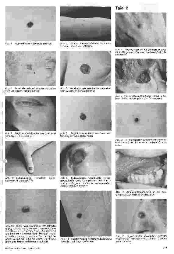 Vorschauseite 4: Der lebensrettende Blick Frühdiagnostik des malignen Melanoms: Wichtig und segensreich