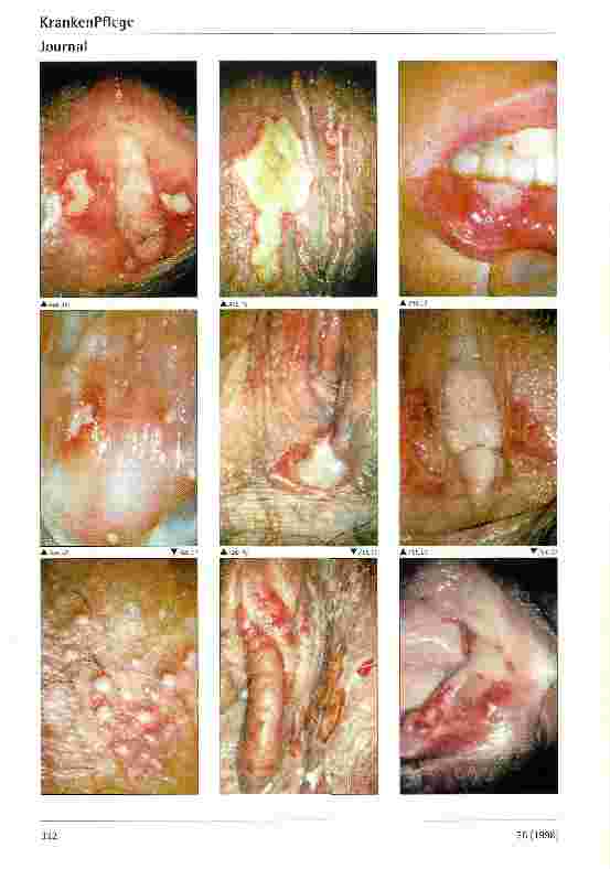 Vorschauseite 2: Klinik und Differentialdiagnostik des Herpes genitalis der Frau