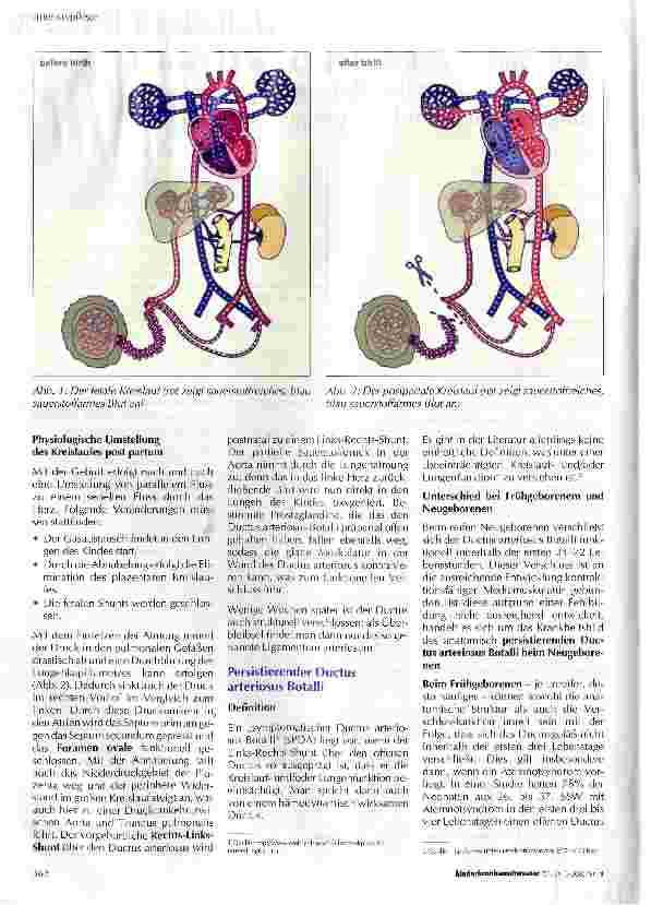Vorschauseite 2: Medikamentöse Therapie des persistierenden Ductus arteriosus ßotalli beim frühgeborenen Kind aus pflegerischer Sicht
