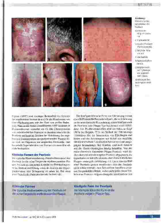 Vorschauseite 3: Psoriasis - neue Erkenntnisse zur Pathogenese und Therapie