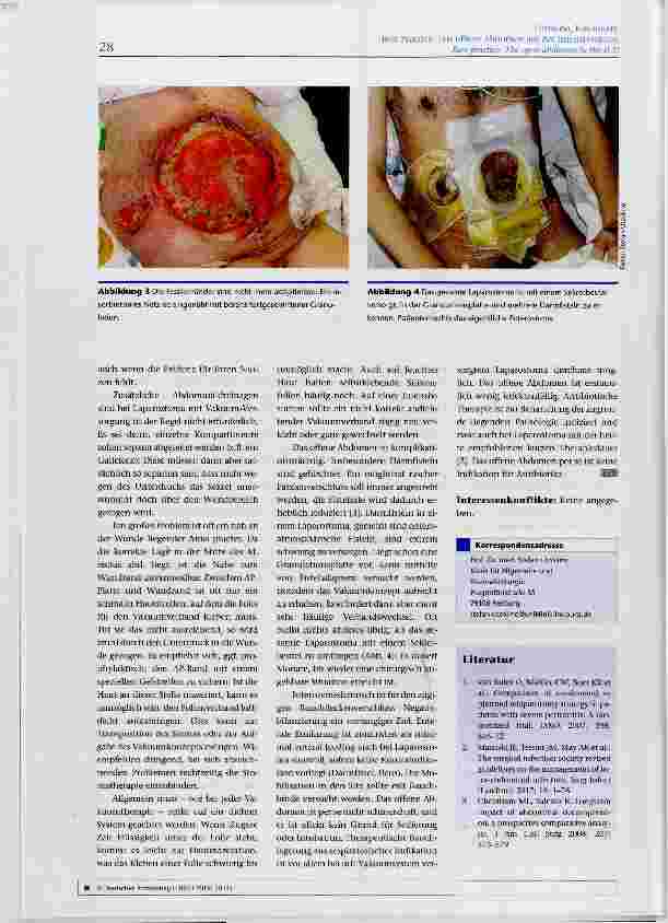 Vorschauseite 3: Best Practice: Das offene Abdomen auf der Intensivstation