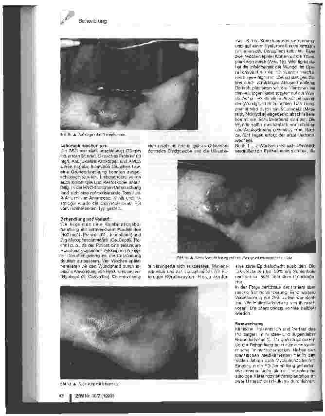 Vorschauseite 2: Autologe Keratinozytentransplantation bei Pyoderma gangraenosum