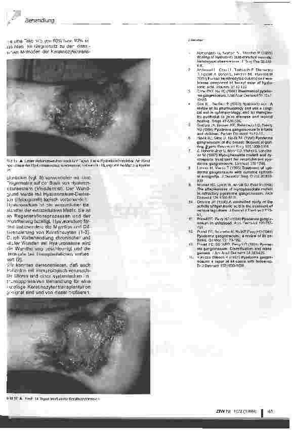 Vorschauseite 3: Autologe Keratinozytentransplantation bei Pyoderma gangraenosum