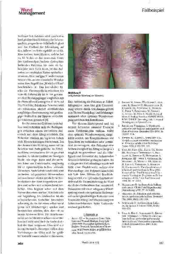 Vorschauseite 4: Atraumatische Wundbehandlung am Beispiel der Epidermolysis bullosa dystrophica