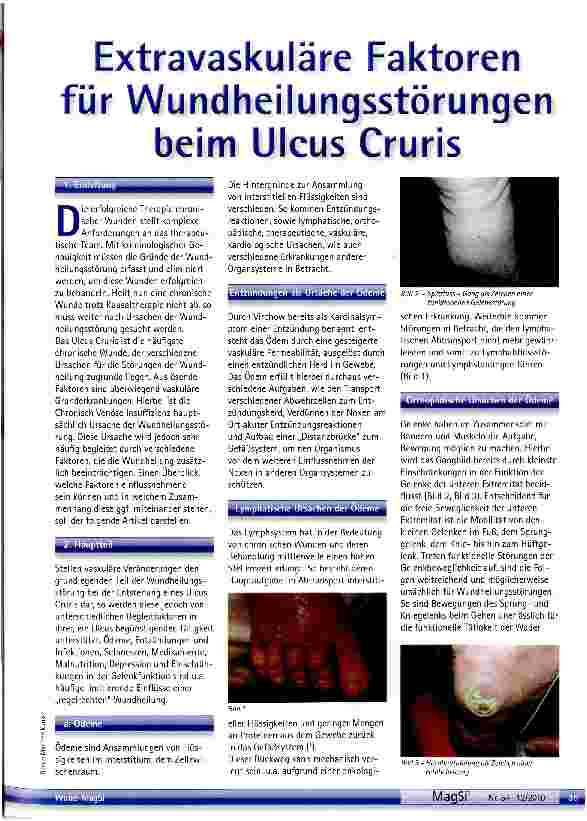 Vorschauseite 1: Extravaskuläre Faktoren für Wundheilungsstörungen beim UIcus Cruris