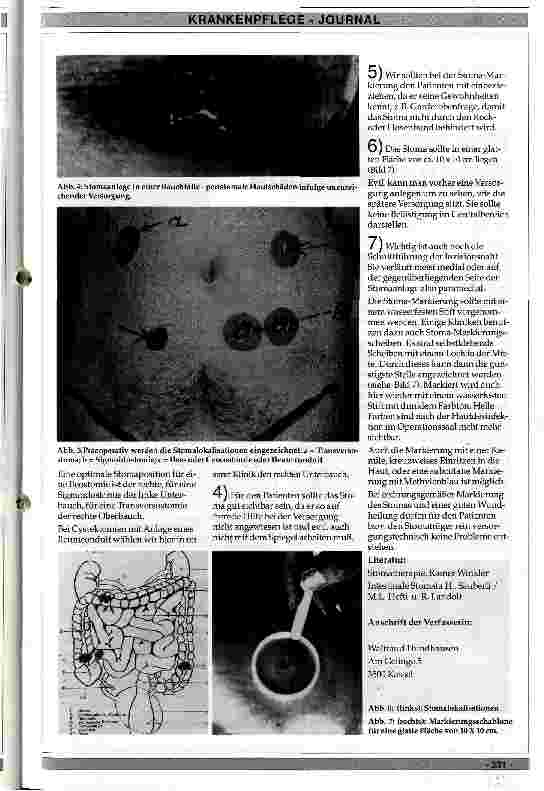 Vorschauseite 2: Die präoperative Stoma-Markierung