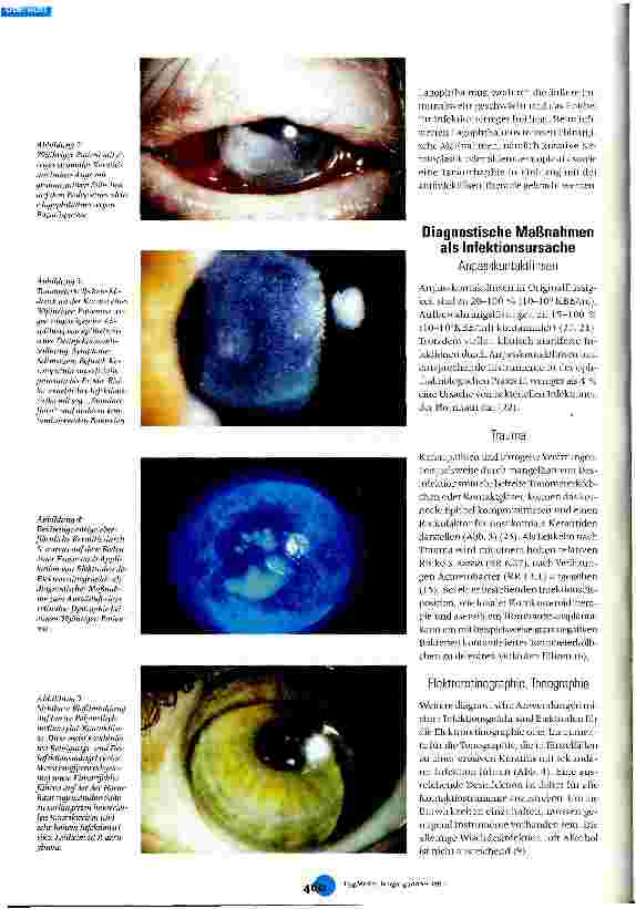 Vorschauseite 3: Nosokomiale Keratitis